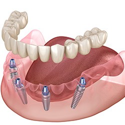 Illustration of implant dentures for lower arch