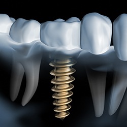 X-ray of a patient with a dental implant 