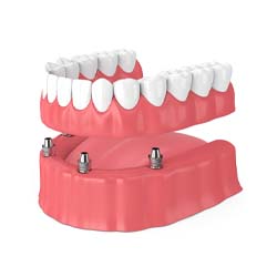 four dental implants supporting an implant denture